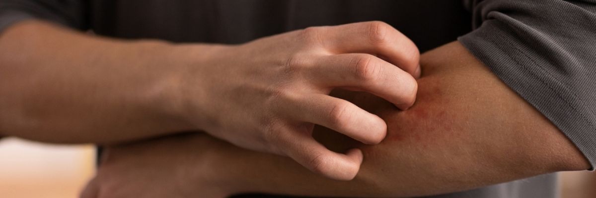 Aloe Vera bei atopischer Dermatitis