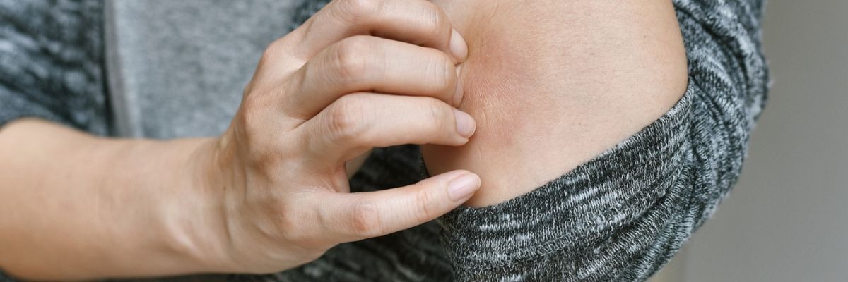 Aloe Vera for Hives: Relief for Your Skin