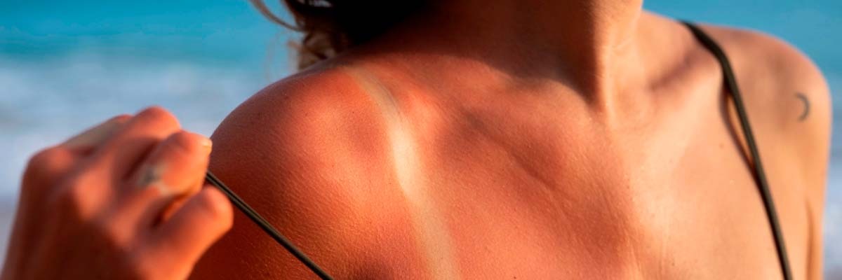 Aloe Vera für Sonnenbrände
